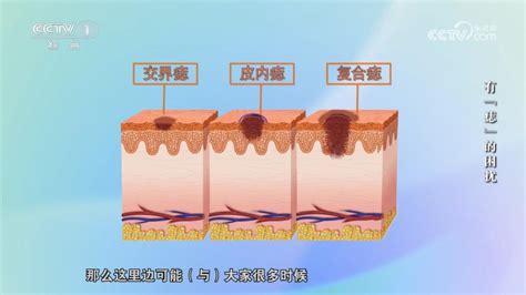 痣很凸|身上的痣能抠吗？凸起的痣和平平的痣哪个更易恶。